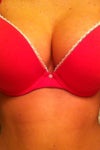 Loss of cleavage in right breast