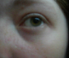 Looks like eye is too close to nasal bone when lightning isn't beneficial...