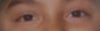 What my eyes used to look like before the drooping