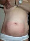 Very sore and tender, after two one hour treatments, back to back (required by the dr)