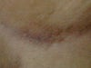 mark on thigh
