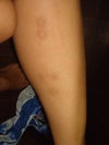 Can 15 year old scars still be treated and removed?