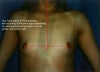Before Image - If there is magnified asymmetry now, actually the OTHER side should be further to the armpit