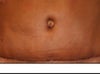 12 days post tummy tuck
