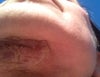 day 5 post op face and neck lift - elephant neck (48 yrs old)