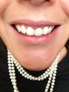 As you are looking-crowns on right side central & lateral.