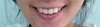 When I smile,I haven't upper lip.