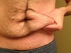 One extra pic to show pinching skin, my skin has always felt more "jiggly" and loose than my friends'