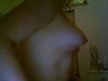 Augmented tuberous breasts