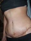 Like this but even after it has been healed for a couple years