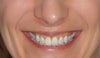 fat between nose and lip... can it be reduced so it doesn't form a big wrinkle?
