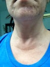The spot on my chin was not there prior to treatment. The other area on the side has not improved and some has worsened.