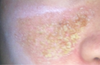 roughly 6-7 days after restore. Did not expect this crust/scab or is this flaking? I have sensitive skin not sure if anything got to do with it. Shredded all on by it self by day 12. very red and pink for several weeks after