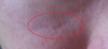 This is when skin is dry front view of the scar with natural light coming in house window. As you can its bearly noticeable compare to other lighting. Lighting makes scar look severe like a deep cut. This is just a pic to show when people see this "mild" scar or "not that bad" but when light hits the area and shadow makes the pitted/crater scar look 100x worse.