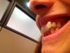 Front teeth slanting inwards