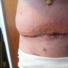 side view of excess flank Thank you for any advice!