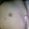 My most recent photo, belly button protruding, flank excess, fat bubble Thank you for any advice!