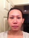 After 6 months. The right nostril is still swollen when the left is not.