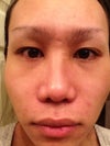 The doctor adjust the bridge to make it look straight. but the problem is the uneven swollen.
