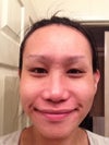 When I smile, its even more noticeable. Even my friends can see it.