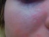 Scars on cheek - most concerned with larger/more indented scar, also similar (but more minor) scar slightly below
