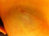 R breast - kenalog injection site - horizontal incision scar