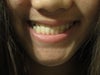 All of my teeth