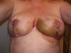 one week ago and getting worse - warm, painful and new bruising since pic