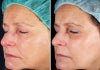 Fractional Laser Before and After Photos