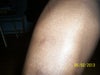 Leg Scar 1 (left leg)