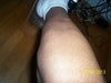 Leg Scar 2 (left leg)