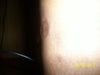 Leg Scar 3 (left leg)