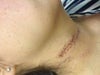 Stitches just removed