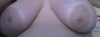 14 years ago I had implants and a lift done