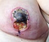 still told me nipple was alive and granulating tissue