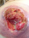 he finally removed dead tissue...all along assured me nipple was going to be ok