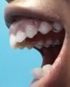 Open view of overbite.