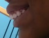 Profile view of overbite.