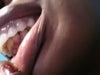 Underneath view of overbite