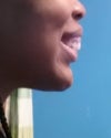 Profile view of my bite.