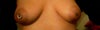Left breast also becoming larger than right