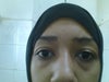 eye bags or tear troughs