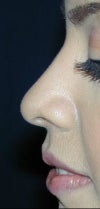 nose before