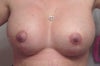5 weeks post op