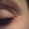 I dont know if u can see them... under my eye brow and under my eye..