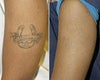 Tattoo Removal Before and After Photos