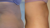 Laser Surgery Before and After Photos
