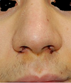 6days post-op