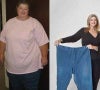 Gastric bypass before & after photos