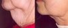 Lipodissolve before & after photos